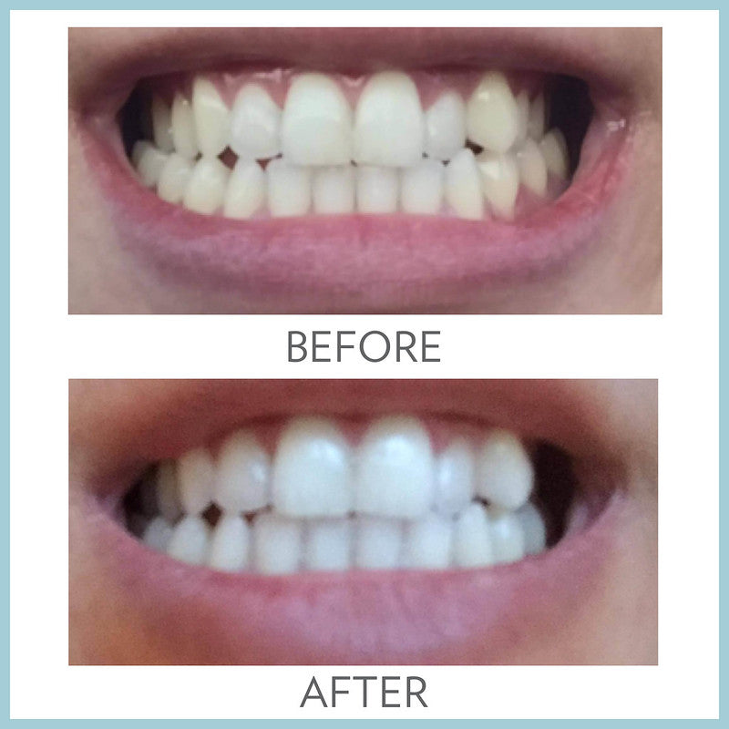 AP 24 Toothpaste vs Whitening Strips: Which Whitens Better?